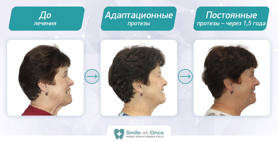 Процесс изменения лица после имплантации зубов