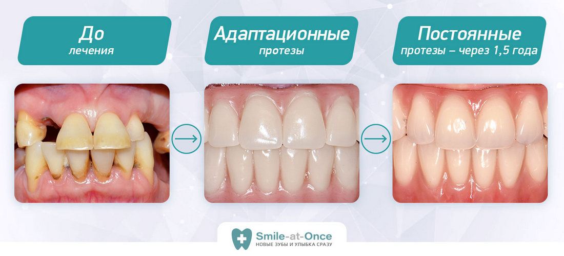 Как изменялись зубы пациентки до и после имплантации