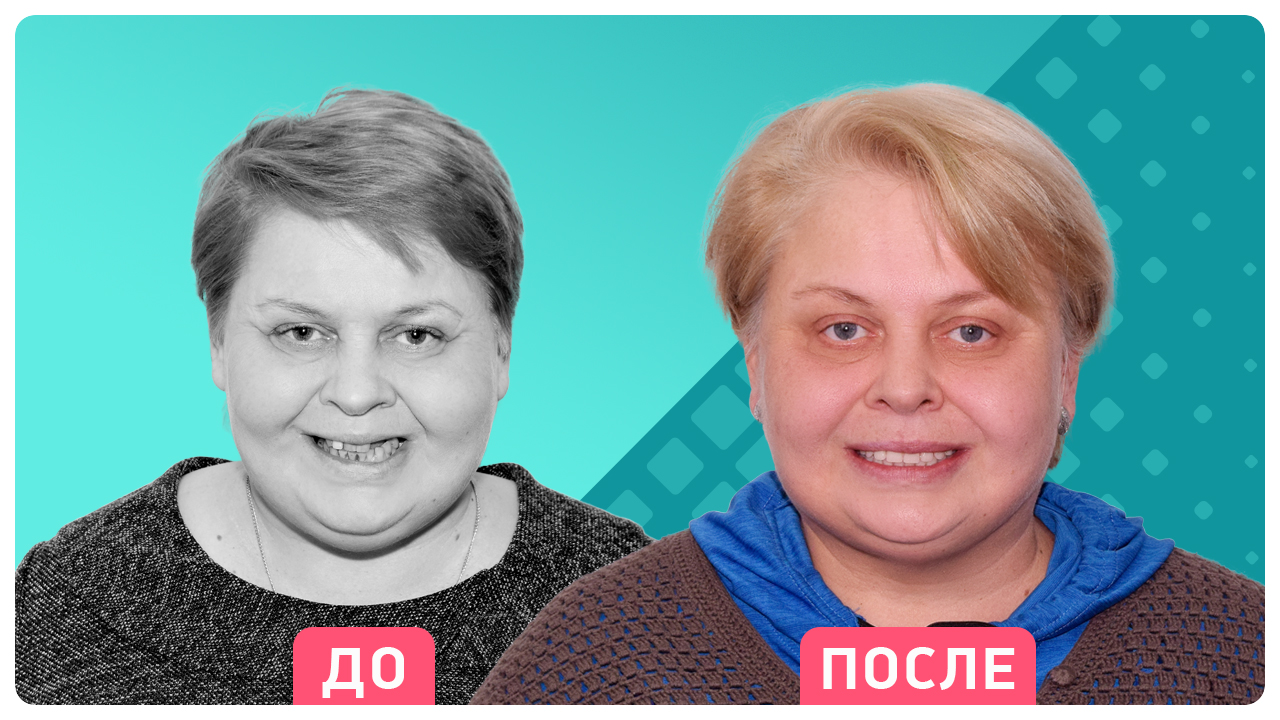 Елена Молодцова - победитель акции Трансформация улыбки