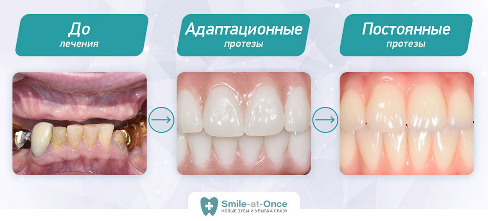 Линия улыбки после имплантации зубов