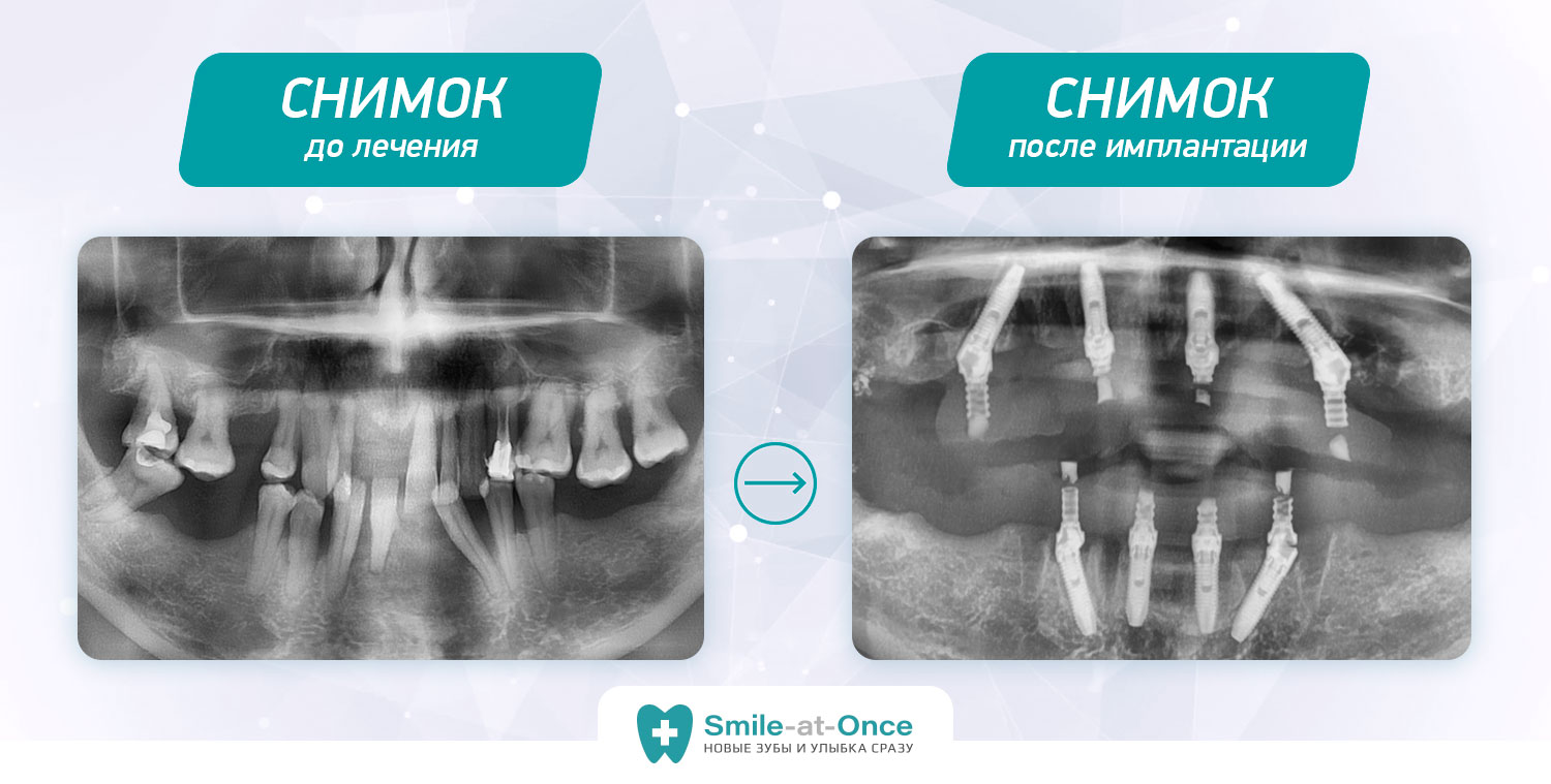 снимок до и после имплантации зубов