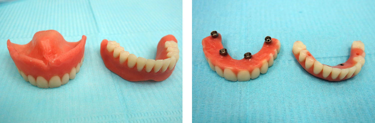 зубные протезы перед установкой