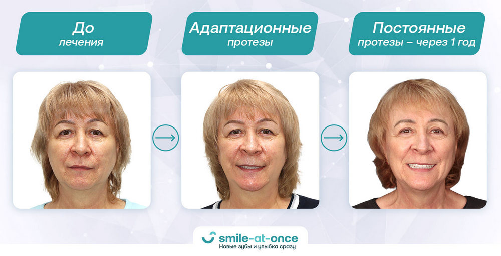 процесс изменения лица у пациента после имплантации зубов