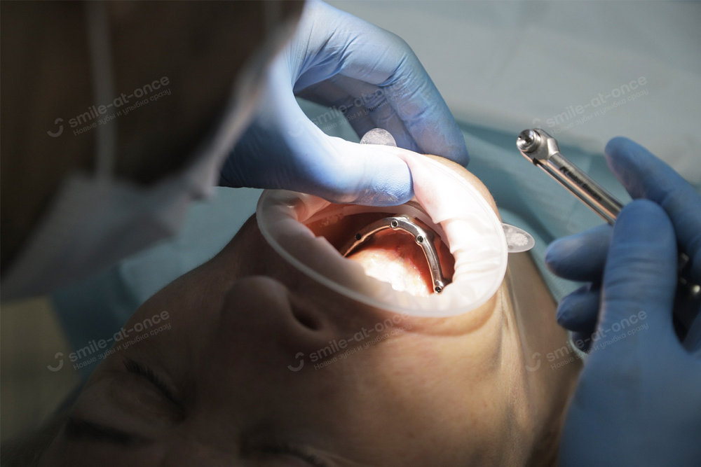Фиксация зубного протеза