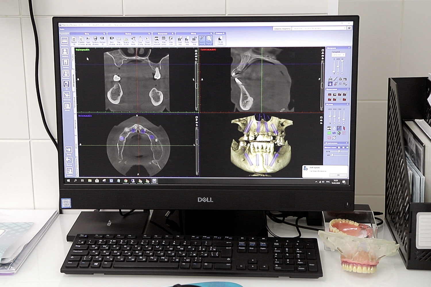 3D-планирование имплантации all-on-4 в NobelClinician