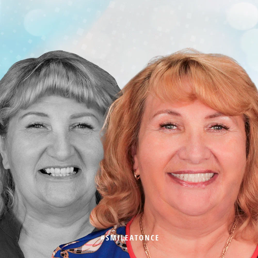 Поспелова Татьяна фото до и после имплантации зубов