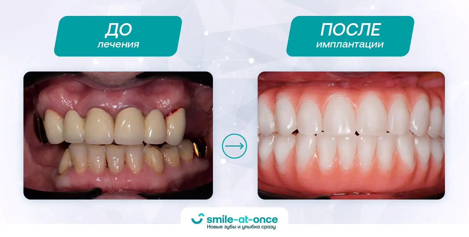 Результат имплантации зубов до и после
