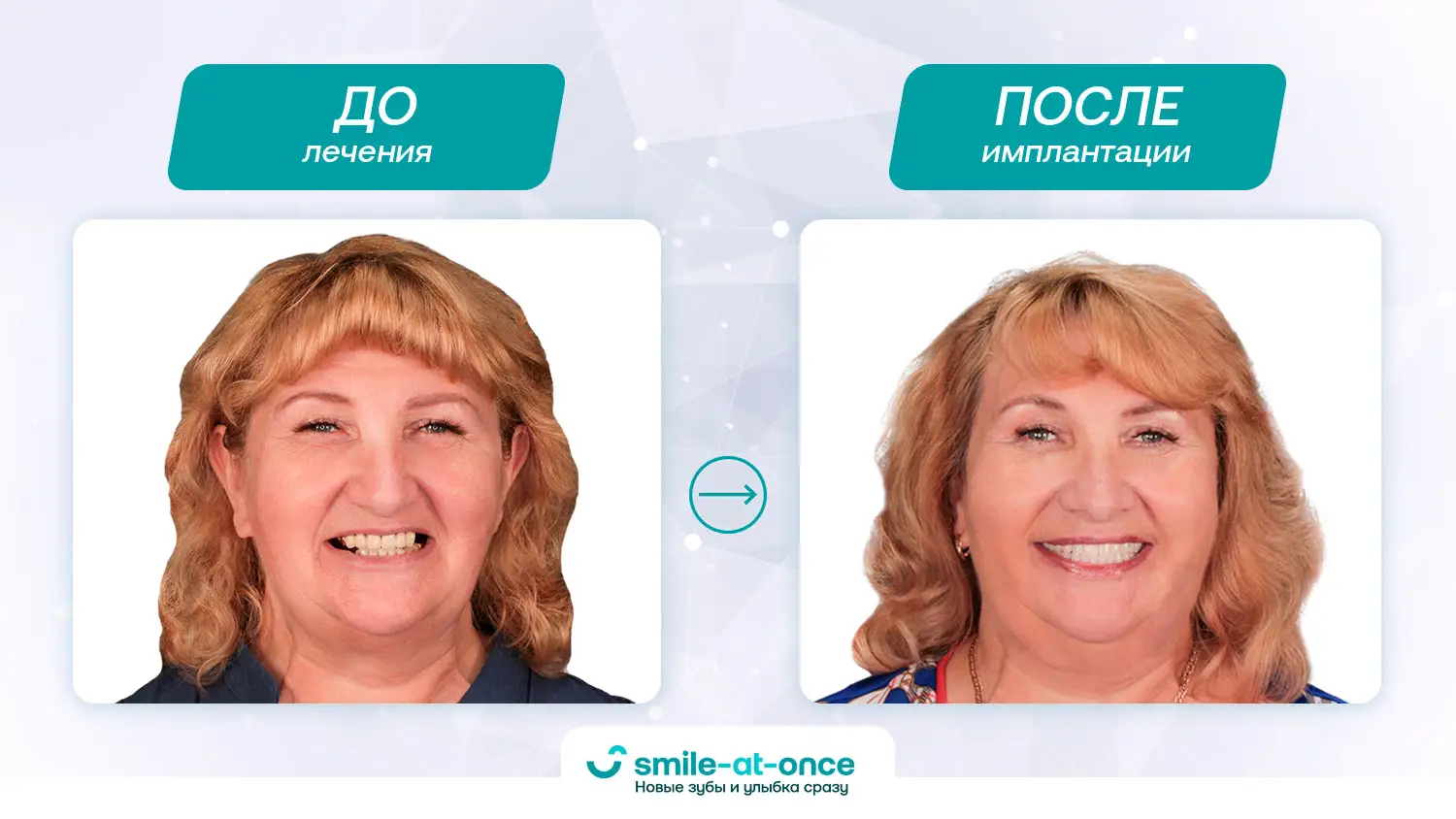 Изменения лица пациентки после комплексной имплантации зубов