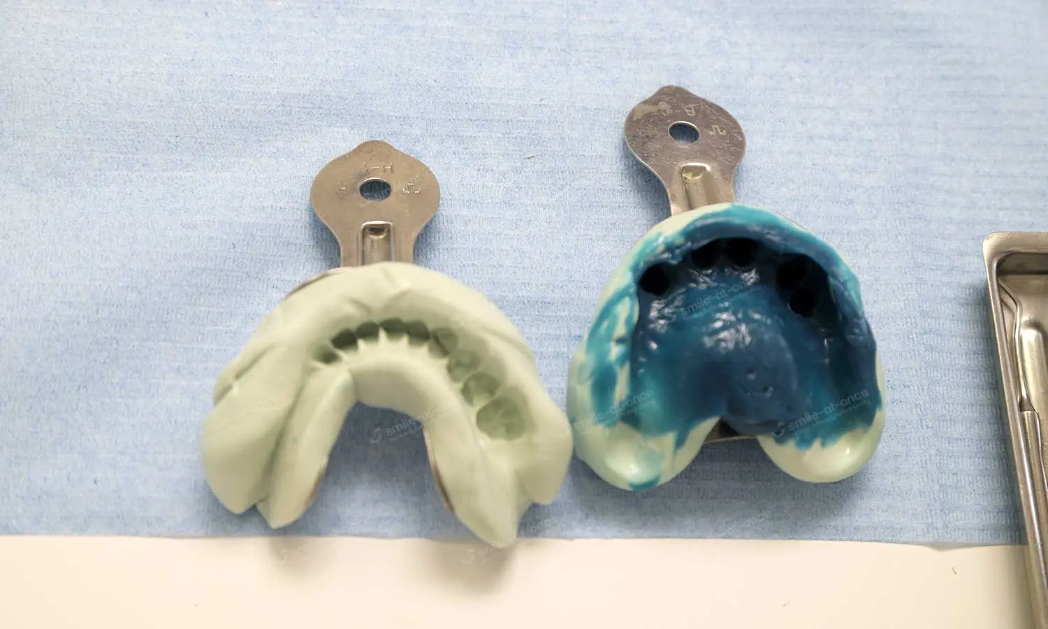 Снятие слепков зубов у пациентки