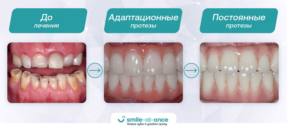 внешний вид зубов до и после операции