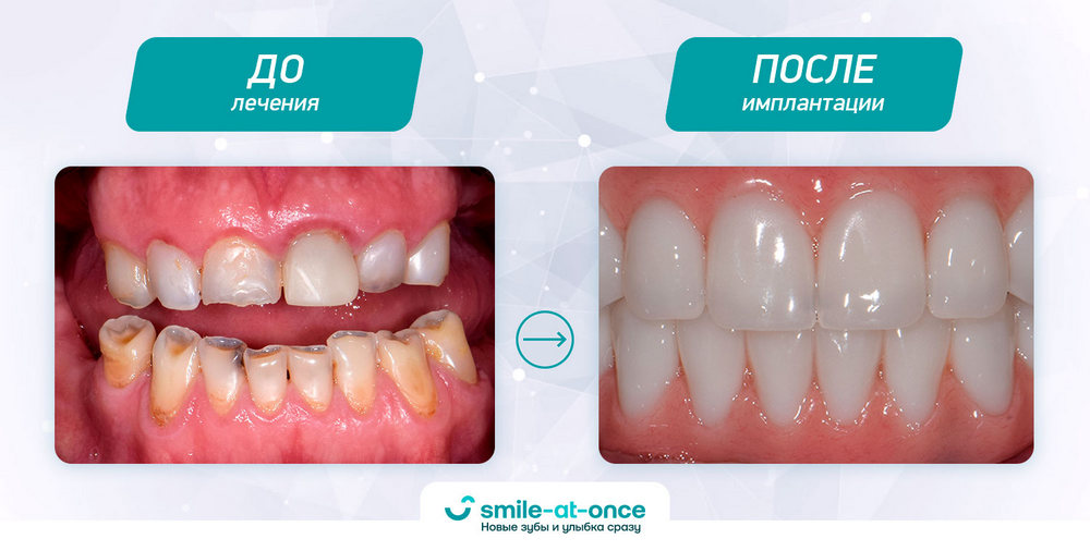 состояние зубов до и после
