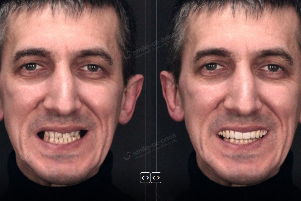 изменения в форме лица до и после