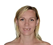 Сидоренко Ольга фото до имплантации зубов