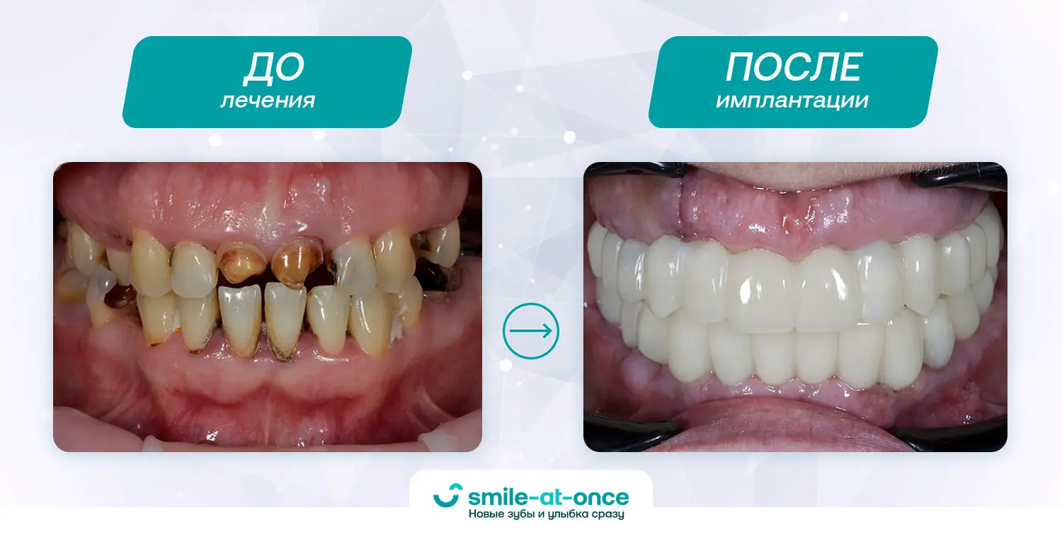До и после установки зубных имплантов