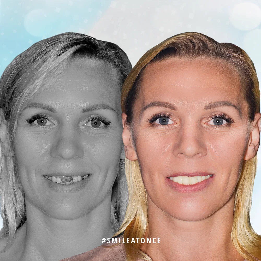 Сидоренко Ольга фото до и после имплантации зубов