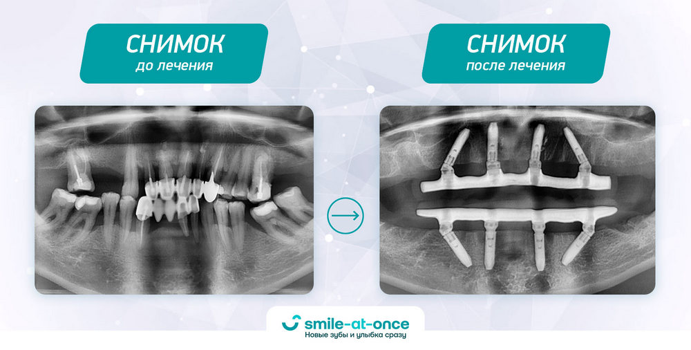 рентген снимок до и после операции по имплантации зубов
