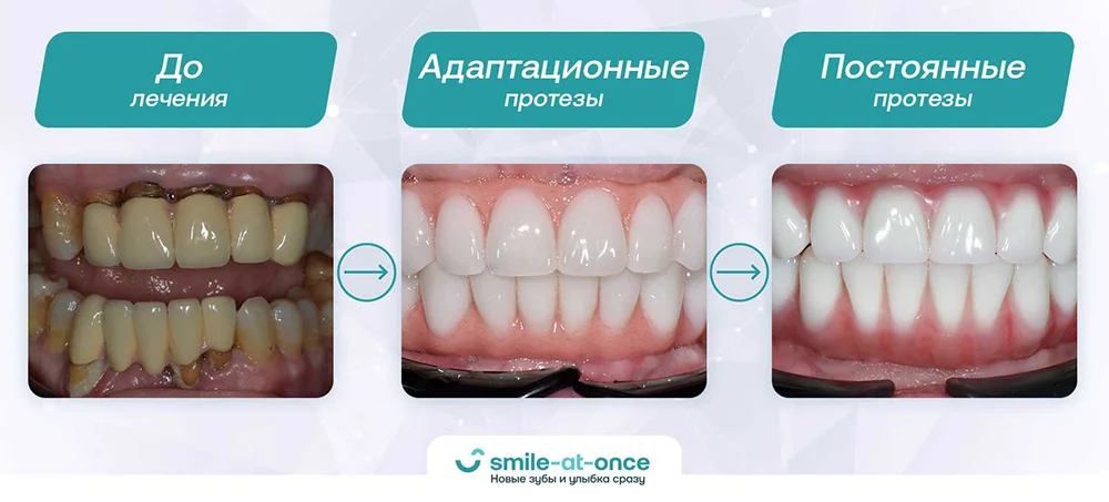 Как изменяются зубы после имплантации и перепротезирования