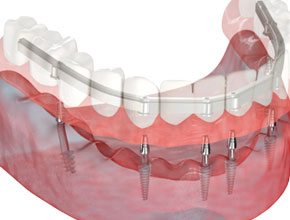 Базальная имплантация зубов