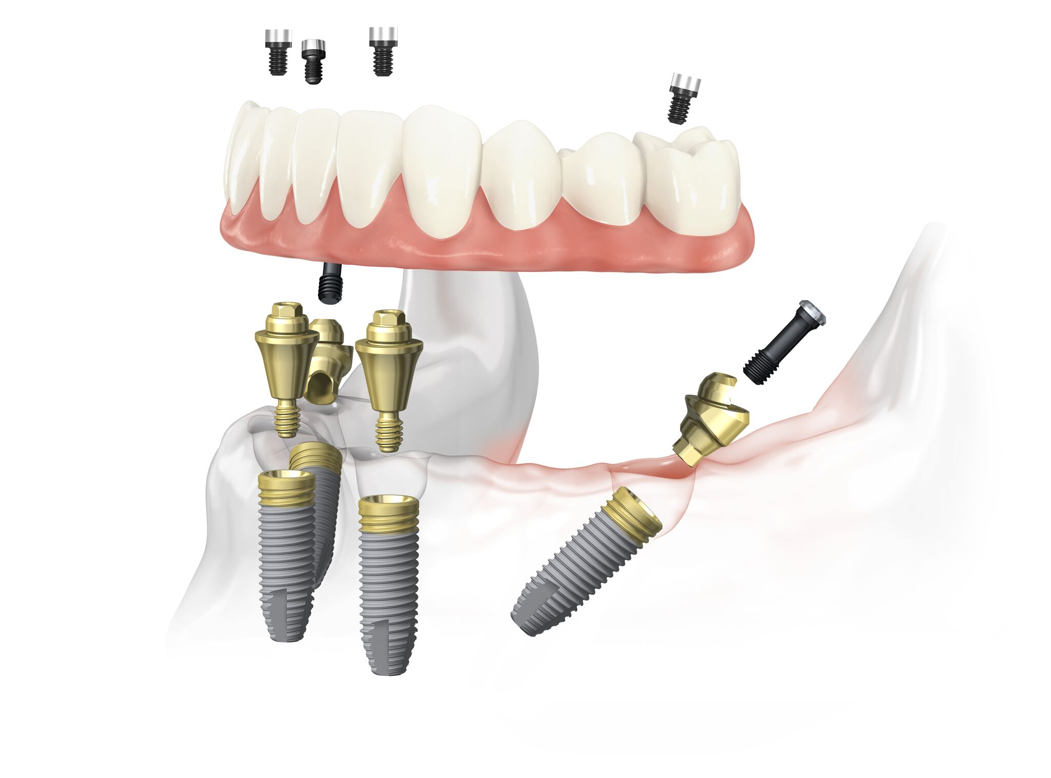 All-on-4 – все зубы на 4 имплантах