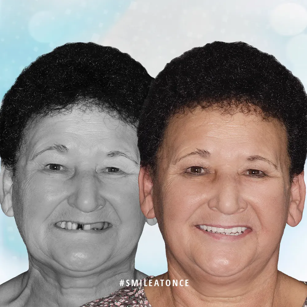 Зульфания фото до и после имплантации зубов